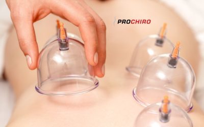 Cupping Therapy in Bozeman